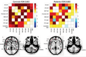 Image: Differences in functional connectivity from rfMRI between autistic patients and age- and gender-matched controls: the major disconnection is between the cerebellum and frontal language regions (Photo courtesy of Prof. Stefan Sunaert, Leuven University Hospital, Belgium).
